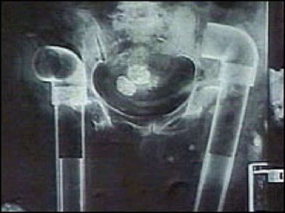 Xray of corpse showing leg bones replaced with pvc piping in alistair cooke body snatching scandal BBC News 2006